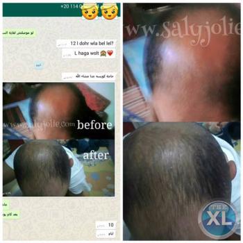 افضل علاج للصلع