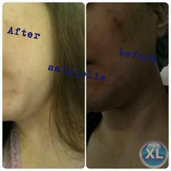 علاج حب الشباب