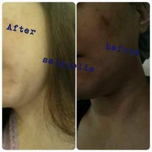 علاج حب الشباب -سالي جولي