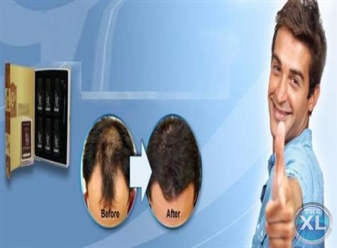 اسبراي سن برست لعلاج تساقط الشعر وتكثيفه